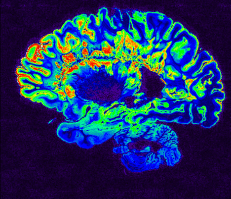 MRI May Prevent Alzheimer&#8217;s Misdiagnosis in Seniors