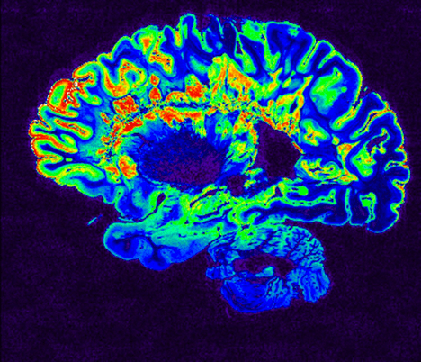 MRI May Prevent Alzheimer’s Misdiagnosis in Seniors